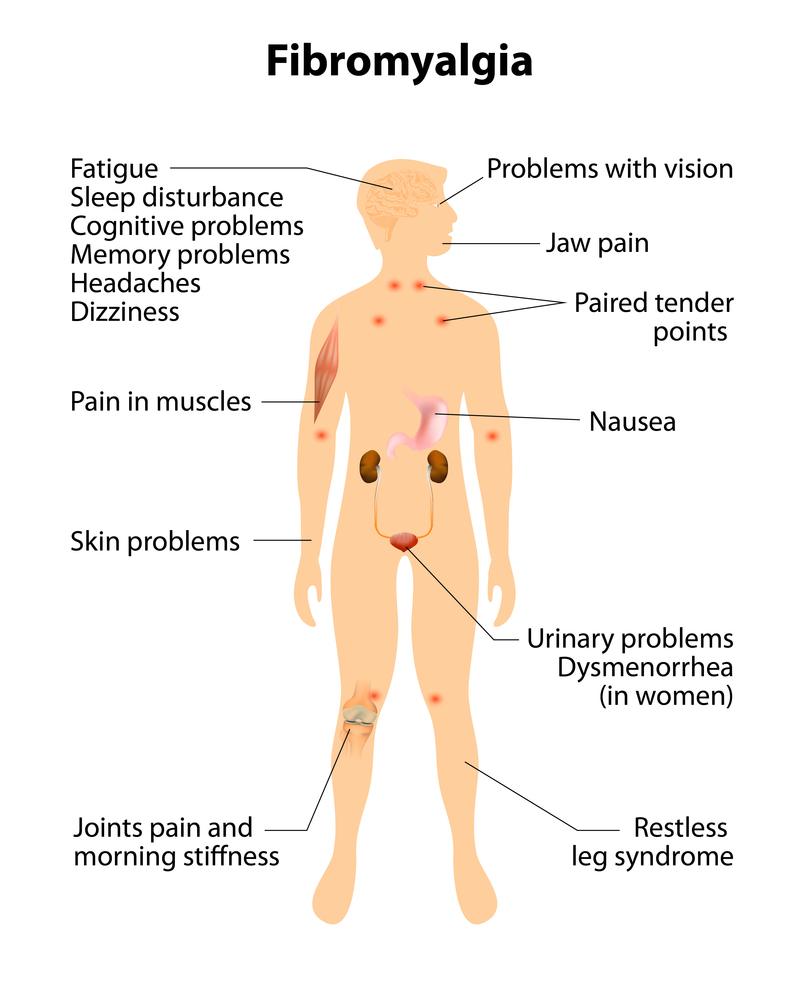 fibromyalgia-tender-points