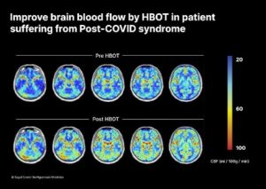 Hyperbaric oxygen treatment is effective in treating long-term COVID-19 symptoms