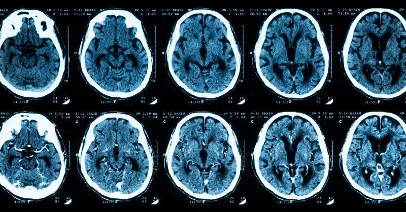 Scans of brains affected by stroke