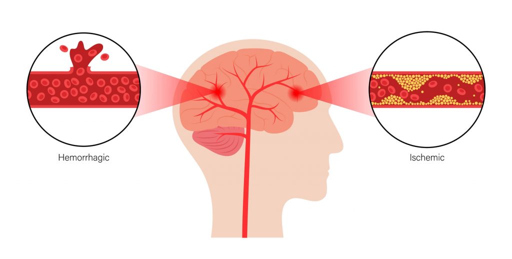 types of stroke 