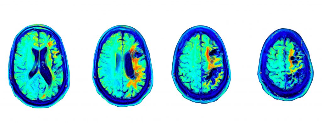 stroke-recovery