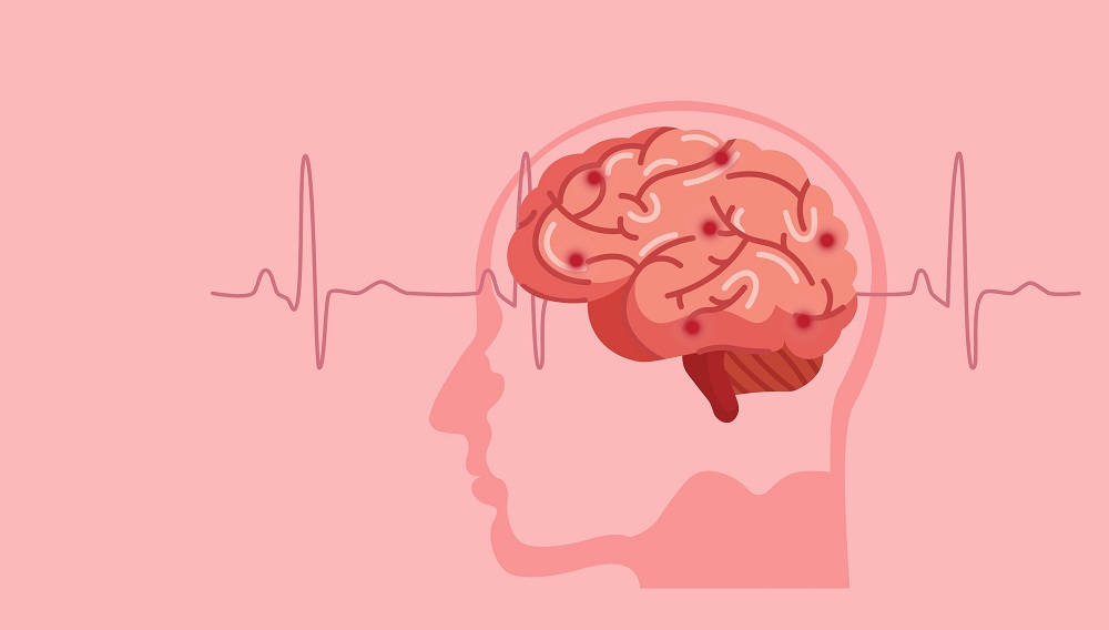 hemorrhagic stroke symptoms