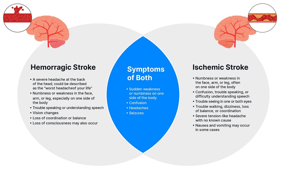 stroke-treatment